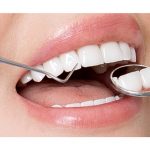 Phương pháp bọc răng sứ thẩm mỹ – Chia sẻ kinh nghiệm từ A đến Z