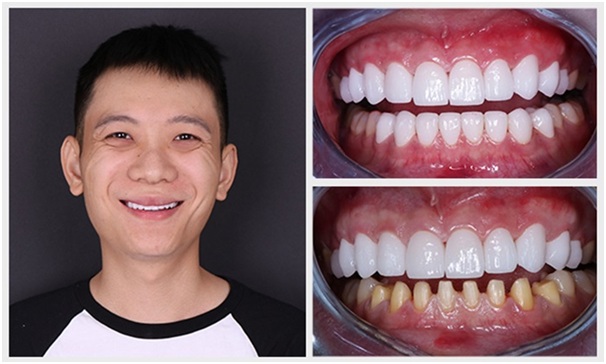 phuong-phap-boc-rang-su1