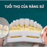 Bọc răng sứ và những thông tin quan trọng mà bạn không thể bỏ lỡ