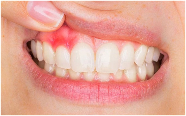 phuong-phap-boc-rang-su3