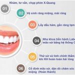 Tìm hiểu quy trình bọc răng sứ đạt chuẩn trong nha khoa hiện nay