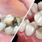 Tìm hiểu về quy trình bọc răng sứ cho răng sâu chuẩn nha khoa
