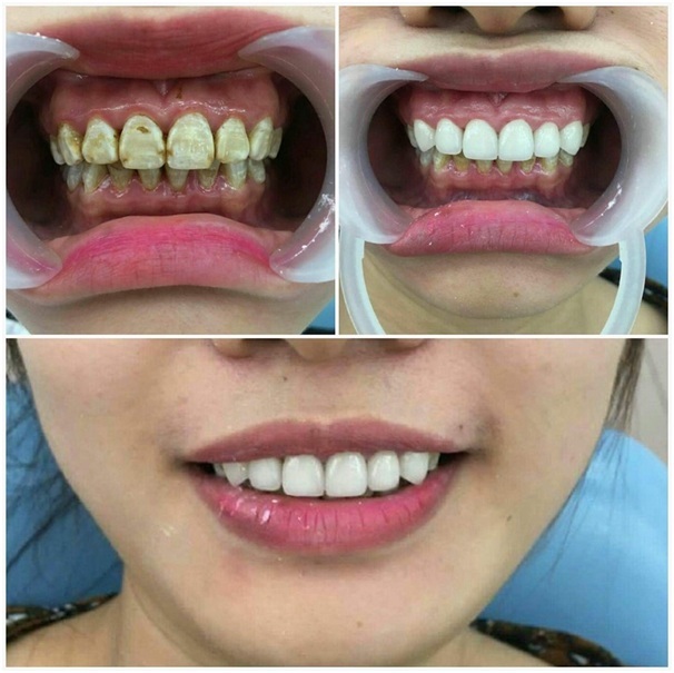 quy-trinh-boc-su-rang-cua1