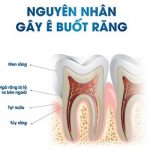 Răng bị ê buốt phải làm sao? Tìm hiểu nguyên nhân và cách phòng tránh