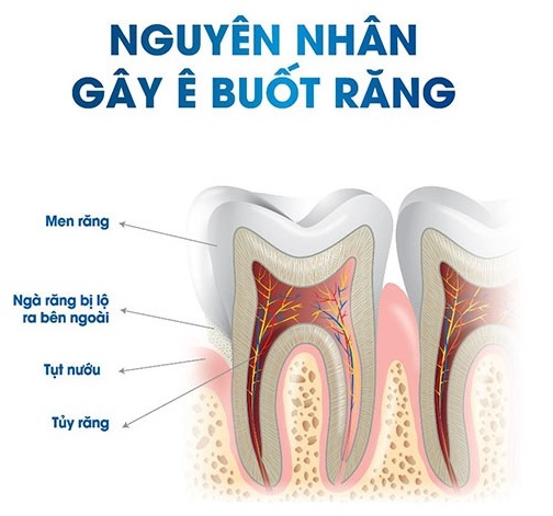 rang-bi-e-buot-phai-lam-sao1
