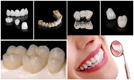 boc-su-rang-ham-nhung-dieu-can-biet3