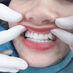 Bọc sứ răng khểnh có thực sự tốt? Quy trình bọc sứ răng khểnh chuẩn nha khoa