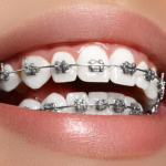 Niềng răng – Định nghĩa và thông tin chi tiết về việc niềng răng