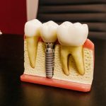 Câu trả lời cho câu hỏi “Cắm implant có đau không” những gì bạn cần biết