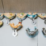 Khám phá những nhược điểm của phương pháp trồng răng implant