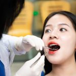 Niềng răng ở tuổi 20: Các thông tin cần biết và câu trả lời