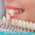 Bọc răng sứ: Thời gian sử dụng và tần suất đổi mới bao lâu?