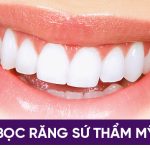 Quy trình bọc răng sứ chuyên nghiệp cho răng sâu – Hướng dẫn và giải đáp