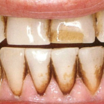 Răng bị đen bề mặt: Nguyên nhân và cách làm trắng nhanh nhất