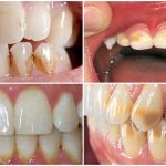 Bọc răng sứ: Câu trả lời chi tiết về đau đớn mà bạn cần biết