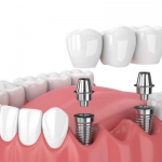 Cách Chăm Sóc Răng Miệng Sau Khi Trồng Implant: Cẩm Nang Vàng Từ Chuyên Gia
