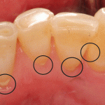 Bao lâu nên lấy cao răng một lần? Bác sĩ khuyên lịch chuẩn theo từng người