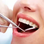 Lấy cao răng có trắng răng không? Sự thật bạn cần biết trước khi quyết định
