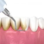 Lấy cao răng có đau không? Câu trả lời từ chuyên gia