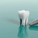 Trồng răng Implant mất bao lâu? Giải đáp chi tiết từ A đến Z cho người lần đầu cấy ghép