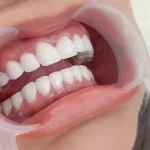 Bọc Răng Sứ Ở Hà Nội Uy Tín, Đẹp & An Toàn?