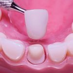 Quy Trình Bọc Răng Sứ Thẩm Mỹ Chuẩn Y Khoa: Chi Tiết Từng Bước Từ A Đến Z