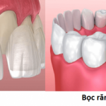 So Sánh Dán Sứ và Bọc Răng Sứ: Đâu là Lựa Chọn Tối Ưu cho Bạn?