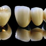 Nên Bọc Răng Sứ Loại Nào Tốt Nhất? Hướng Dẫn Chi Tiết