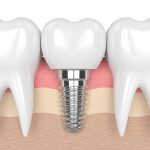Trồng Răng Implant Tại Hà Nội: Giải Pháp Vàng Phục Hồi Răng Mất Vĩnh Viễn Và Ngăn Ngừa Tiêu Xương