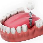 Quy Trình Cấy Ghép Implant Nha Khoa Tiêu Chuẩn Quốc Tế