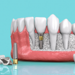 Trồng Răng Implant Có Đắt Không?
