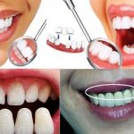 Bọc Răng Sứ Có Hôi Miệng Không? Giải Mã Nguyên Nhân Và Cẩm Nang Chăm Sóc Toàn Diện