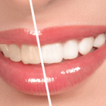 Tẩy Trắng Răng: Cẩm Nang Toàn Diện Từ A-Z