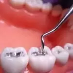 Hàn răng sâu có tốt hay không? Cần lưu ý những điều gì?