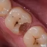 Trẻ bị sâu răng hàm cần phải làm gì? Có nên nhổ hay không?