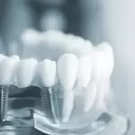 Trồng răng Implant tại Bọc răng sứ thẩm mỹ Hà Nội