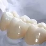 Bọc răng sứ Cercon là gì? Ưu điểm và cách chăm sóc hiệu quả