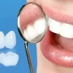 Thực hư bọc răng sứ có hại không? Những điều bạn phải biết khi bọc