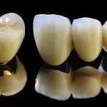 Bọc răng sứ Titan: Đối tượng, quy trình và những lưu ý sau khi bọc