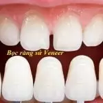 Bọc răng sứ Veneer có tốt không? Có đau không? Giá bao nhiêu tiền?