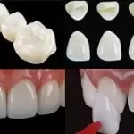 Bọc răng sứ nên chọn loại nào? Răng sứ loại nào tốt nhất hiện nay?