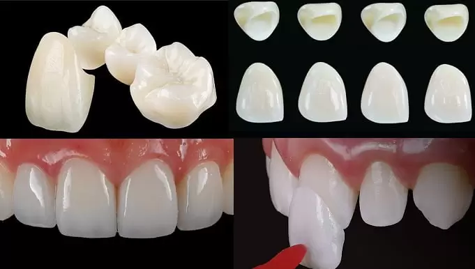 chon-rang-su-loai-nao