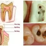 Điều trị tủy răng có đau và ảnh hưởng gì không? Giá bao nhiêu?
