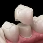 Kinh nghiệm bọc răng sứ chọn loại răng nào? Lưu ý gì trước khi bọc?