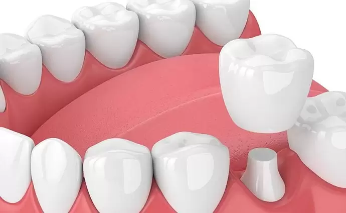 kinh-nghiem-boc-rang-su