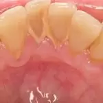 Lấy cao răng bằng máy siêu âm: Giá cả và ưu điểm