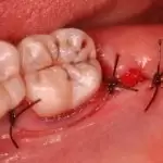 Nhổ răng khôn không đau: Khi nào nên nhổ và những lưu ý