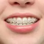 Giải đáp thắc mắc “Niềng răng có đau không?”