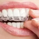 Niềng răng Invisalign là gì? Có đau không? Khi nào nên niềng?