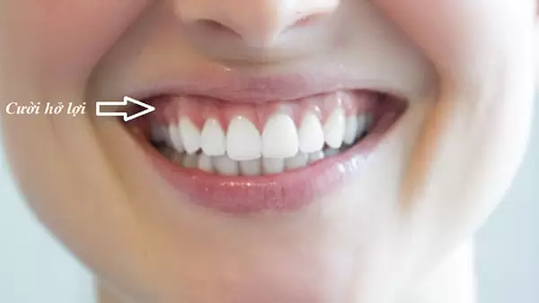 phau-thuat-cuoi-ho-loi